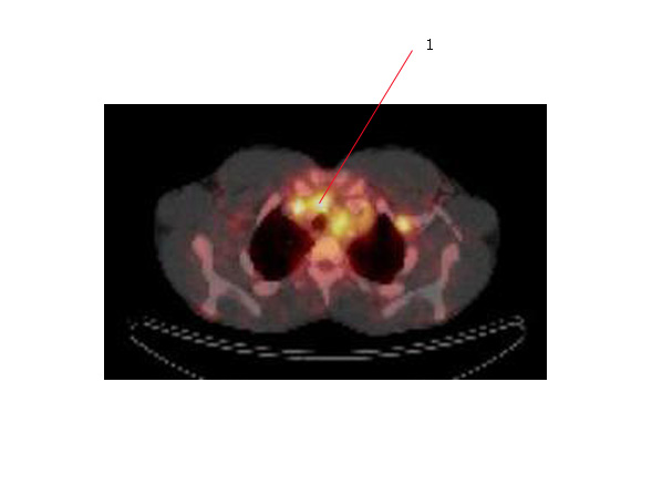 The PET scan below is an axial