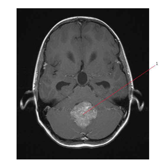 Ependymoma Ct