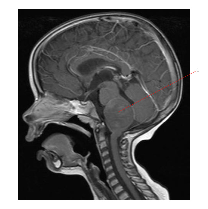 Brain Stem Glioma Signs and Symptoms