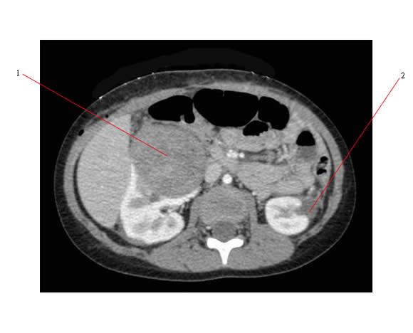 Wilms Tumor Location