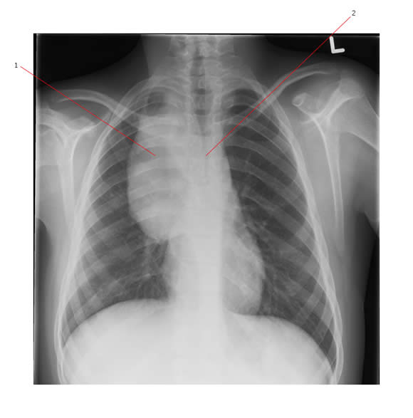 chest-x-ray-mediastinum-and-hilum-anterior-mediastinal-mass